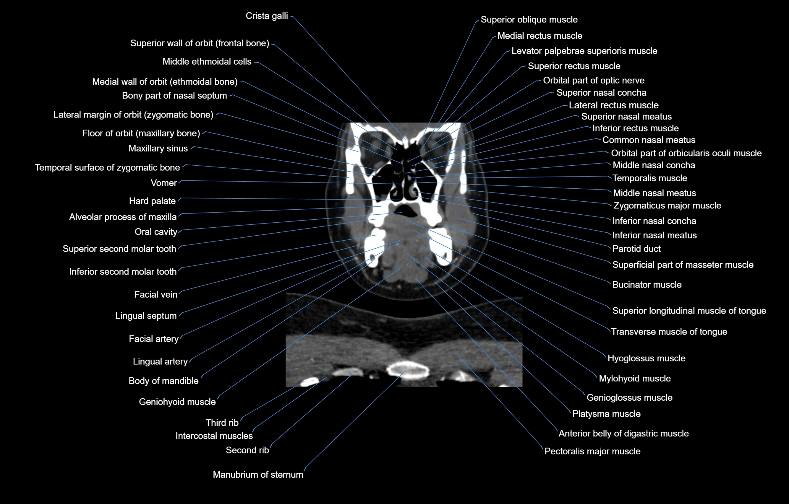 CT Neck coronal  cross sectional anatomy labelled 3D  radiology  image-00019.webp